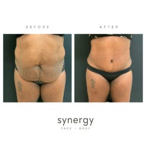 tummy tuck, abdominoplasty, lipo, liposuction