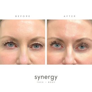 Before + After photos of an Upper Blepharoplasty performed by Double-Board Certified Plastic Surgeon Dr. Hughes in Raleigh, NC. **Do not share or distribute photos without written permission from Synergy Face + Body.