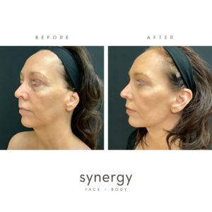 facelift, surgical facelift, Lower Blepharoplasty, Blepharoplasty