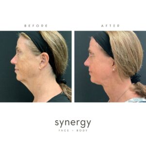 Patient photos are from FaceTite with Submental Lipo performed by Double-Board Certified Plastic Surgeon Dr. Hughes in Raleigh, NC. **Do not share or distribute photos without written permission from Synergy Face + Body.