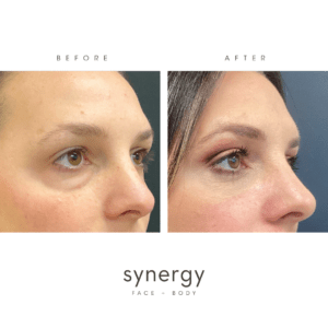 Before + After photos of a Lower Blepharoplasty performed by Double-Board Certified Plastic Surgeon Dr. Hughes in Raleigh, NC at Synergy Face + Body.