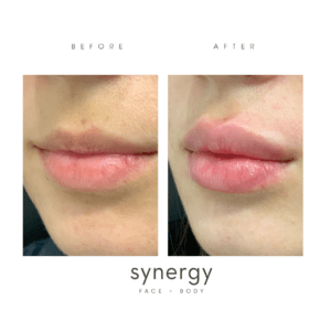 filler, juvederm, volbella