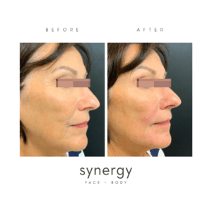 juvederm, filler