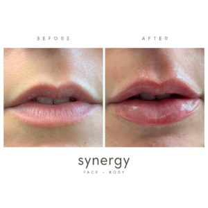 lip filler, Restylane