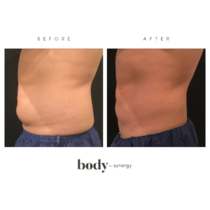 coolsculpt, freeze fat, coolsculpting, body contour