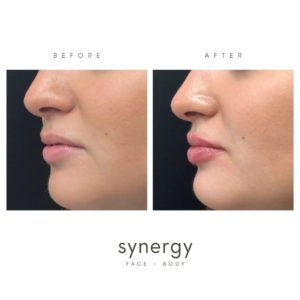 juvederm, filler, juvederm ultra