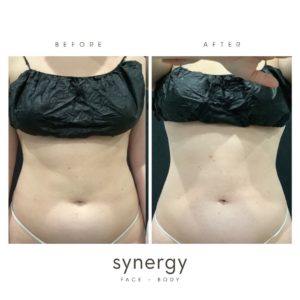 cool sculpt, freeze fat, body contour, coolsculpting