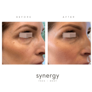 tear trough filler, voluma, restylane