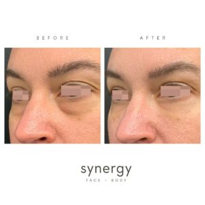 tear trough filler, voluma, restylane