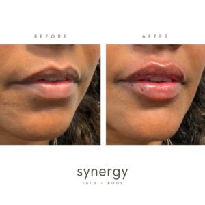 lip filler, Restylane, Kysse, filler