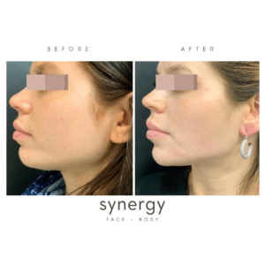 filler, juvederm, voluma