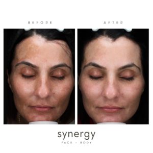 moxi, laser, skin laser results