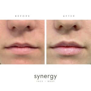 lip filler, Restylane, Kysse, filler